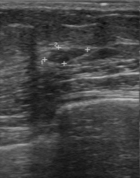 breast lesion ultrasound image from BUS-BRA