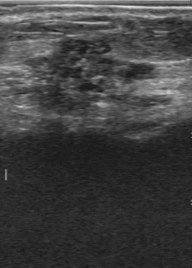 breast lesion ultrasound image from BUS-BRA