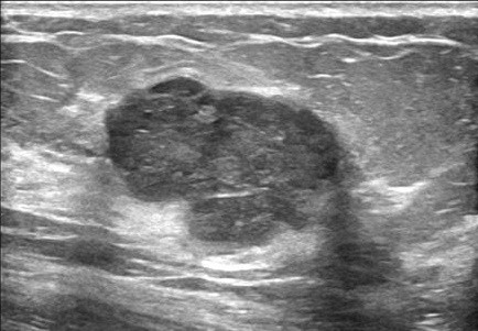 breast lesion ultrasound image from BUSI-WHU
