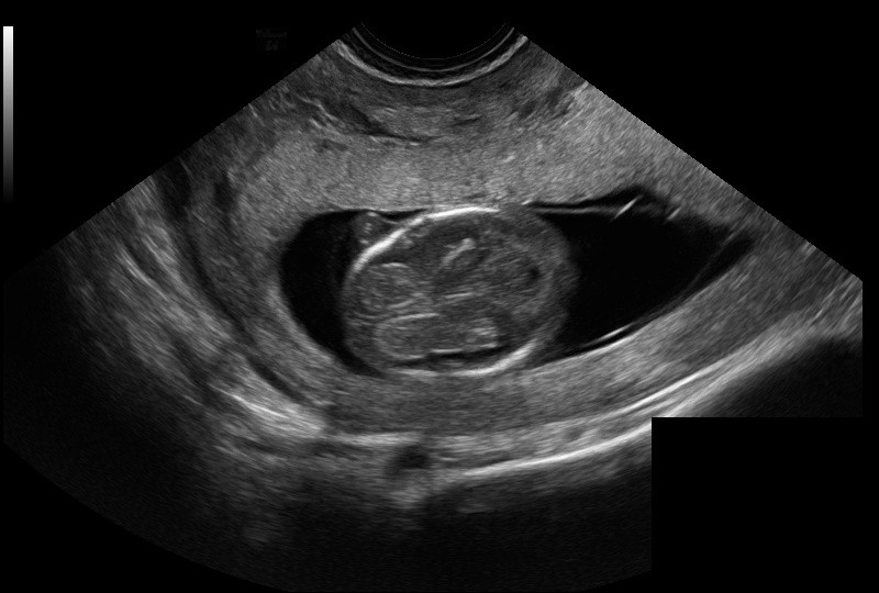 fetal head ultrasound image from HC18