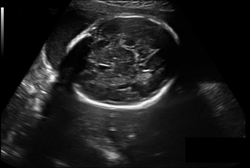 fetal head ultrasound image from HC18