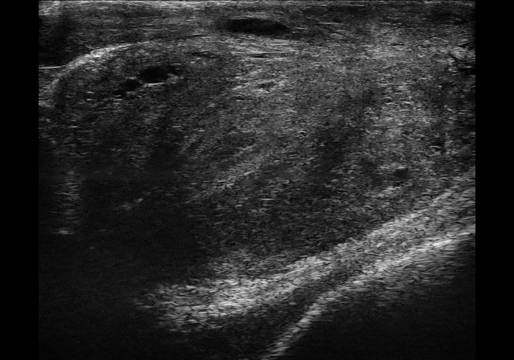 prostate (micro-US) ultrasound image from MUP